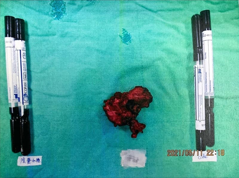 hernia-mesh-pustule
