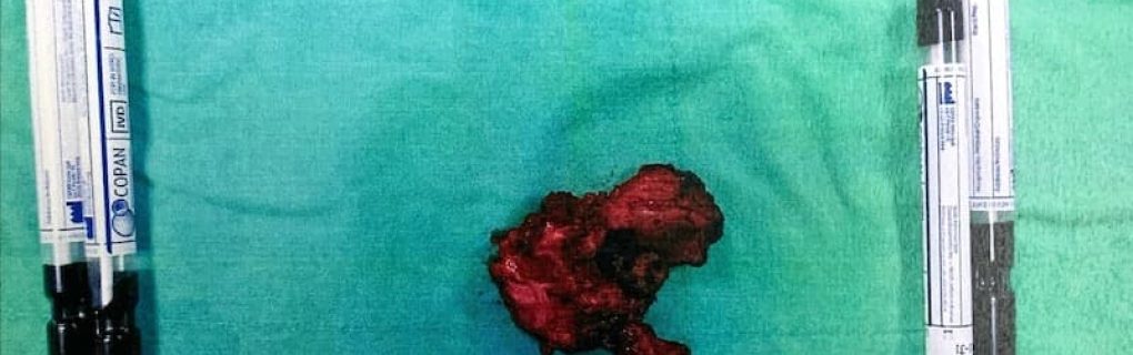 hernia-mesh-pustule