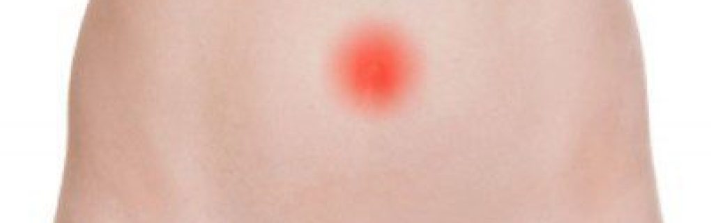 m_umbilical-hernia